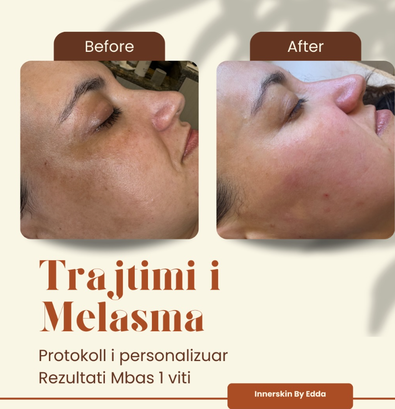 Trajtim i Avancuar dhe i Personalizuar për Melasmën – Innerskin by Edda
