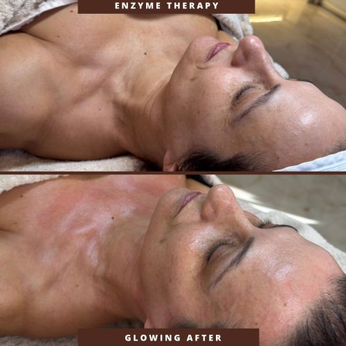 DMK Enzyme Therapy – Trajtim Funksional për Normalizimin e Lëkurës në InnerSkin by Edda