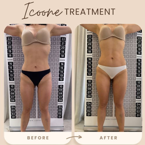 Icoone Laser Med – Teknologjia e Gjeneratës së Fundit për Rimodelim Trupi dhe Përmirësim të Lëkurës