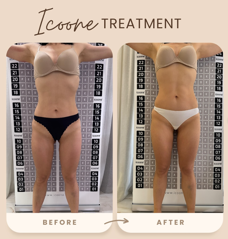 Icoone Laser Med – Teknologjia e Gjeneratës së Fundit për Rimodelim Trupi dhe Përmirësim të Lëkurës