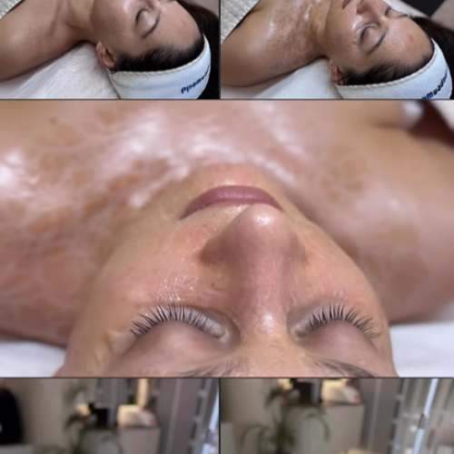 Peeling Kimik Profesional – Rinovim i Kontrolluar i Lëkurës në InnerSkin by Edda