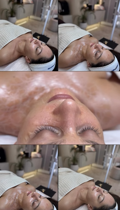 Peeling Kimik Profesional – Rinovim i Kontrolluar i Lëkurës në InnerSkin by Edda